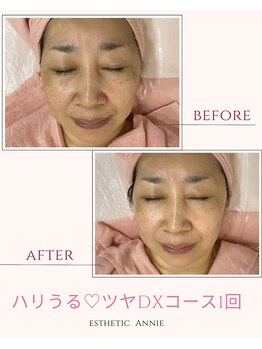 アニー(Annie)/フェイシャル