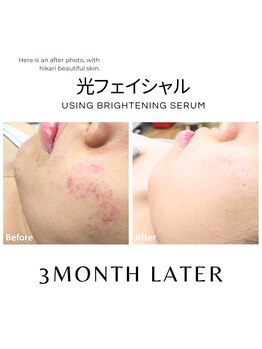 ハグミー 甲子園口(HUGME.)/ニキビケア/赤みケアが得意