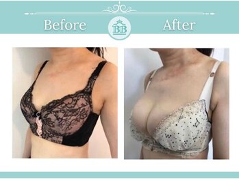 美人バスト 千早店/バストアップ◇育乳症例◇