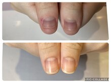 自爪育成導入サロン★短い爪/深爪/噛み爪/幅広/巻き爪もお任せ!