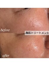 シュカ(Shuka)/ハーブピーリング