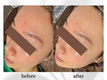 アン ビューティー(ann beauty)/施術1回【症例写真】20代女性