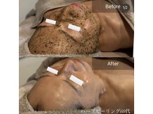 クレシア(CRECIA)/50代ハーブピーリング