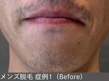 オアシスラグーン(OASIS LAGOON)/メンズ脱毛（症例1 before）