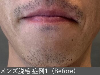 オアシスラグーン(OASIS LAGOON)/メンズ脱毛(症例1 before)