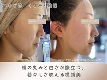 ビカオ(BIKAO)/ハーブピーリング