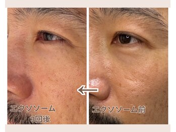 ルビーミー(Ruby's Me)/テラボーラー×エクソソーム症例