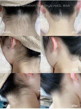 エムズスタイル ネイルバー(M's Style NAIL BAR)/うなじ脱毛