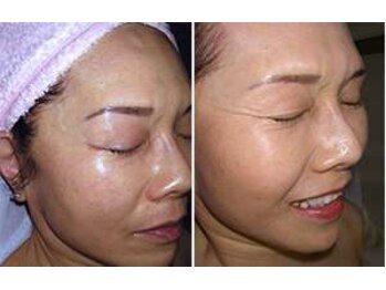 ビソウ(Biso)/ハーブピーリング