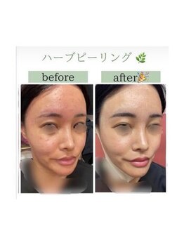 インディバケアプラチナム 横浜店/ハ-ブピ-リング≪フェイシャル≫