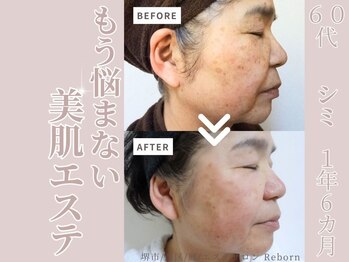リボーン(Reborn)/６０代　シミケア(1年6ヶ月)
