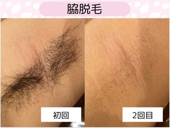 ウルル 金山駅前店(ULULU)/ワキ脱毛