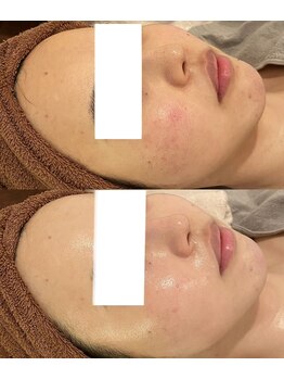 ミベル(MeBell)/【アンストレス】施術直後