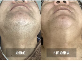 リリー(RILY)/【ビフォーアフター】