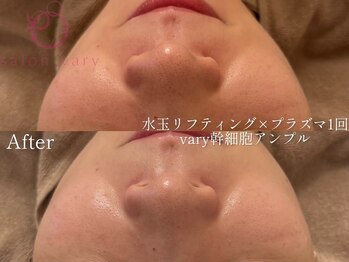 サロンヴェアリー 広尾(salon vary)/美容液導入、毛穴、ニキビ殺菌