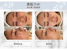 ◆光フェイシャル◆赤み・シミ・ニキビ・ハリツヤ・コラーゲン