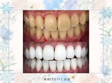 ホワイト つくば店(WHITE)/歯のビフォーアフター