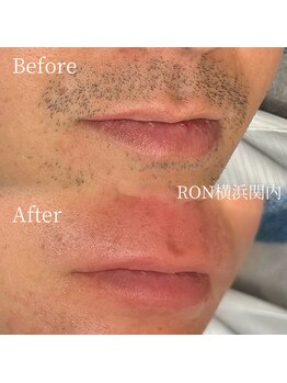 サロンロン 横浜関内(SALON RON)/口周りの頑固な髭/美容電気脱毛