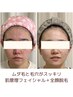 毛穴ケア顔のくすみ、疲れ顔の方へ！【全顔脱毛×肌管理フェイシャル】60分