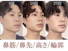 隆鼻矯正専門店 ラプリ(Raplit)/隆鼻＋輪郭矯正40分30回