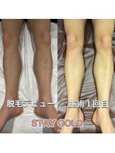 ステイゴールド 新百合ヶ丘(STAY GOLD)/足脱毛デビュー！