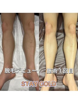 ステイゴールド 新百合ヶ丘(STAY GOLD)/足脱毛デビュー!