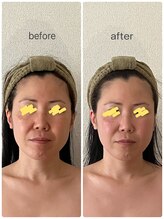 レン(REN)/造顔（小顔）マッサージ40分