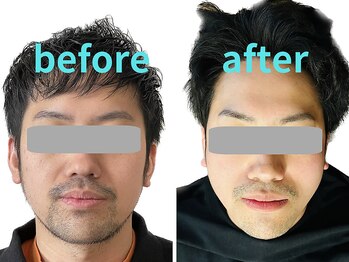 ゼン整体(ZEN)/小顔矯正2回目と13回目の比較