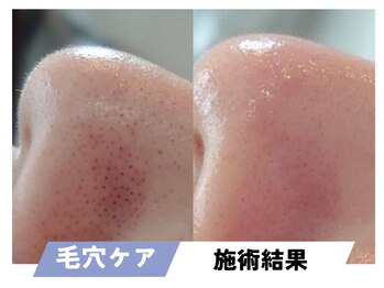 セルフィッシュビューティー/毛穴ケア／施術結果