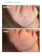 エム(M)/ハーブピーリング