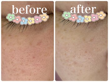 パール(PEARL)/施術前後