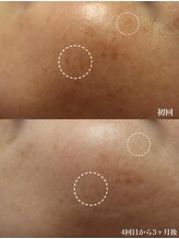 ベビースキン(baby skin)/シミ改善