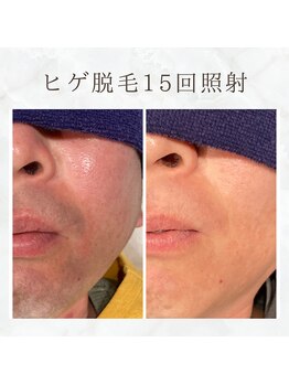 ボゴス(BOGOSS)/ヒゲ脱毛15回照射