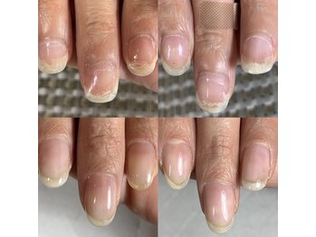 ロイヤル ネイルサロン(Royal nail Saloon)/トラブル爪の自爪育成