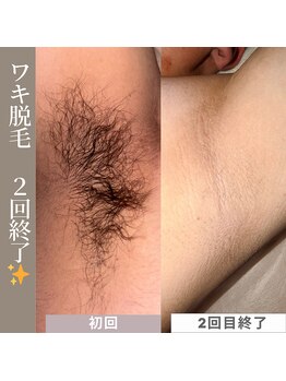 アカラビューティー(Akala Beauty)/ワキ脱毛〈２回終了！〉