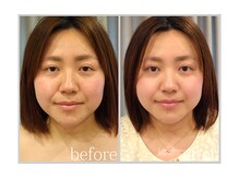 アン グレーヌ 自由が丘(unegraine)/筋肉トリートメントで引き上がる