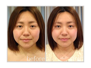 アン グレーヌ 自由が丘(unegraine)/筋肉トリートメントで引き上がる