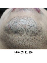 レイ(R.E.I)/【脱毛ビフォー】あご下・首