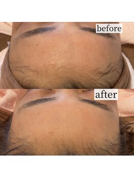 チアリー(Chiary)/フェイシャルワックス/顔脱毛