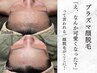 【学割U24】プラズマ顔脱毛で“つるんっ”と垢抜けフェイス◎