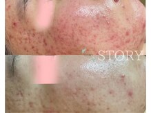 ストーリー(STORY)/ハーブピーリング専門店STORY