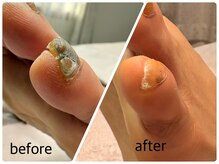 あし処 トコトコ(tocotoco)/小指の肥厚爪