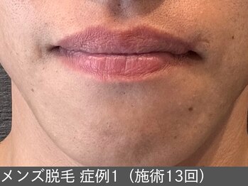 オアシスラグーン(OASIS LAGOON)/メンズ脱毛(症例1 施術13回)