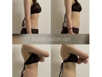 アピ(api)/症例写真【インディバ】