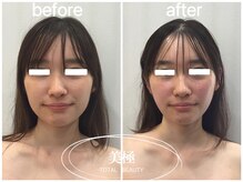 美極 銀座店/銀座/小顔コルギ/小顔矯正