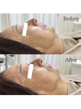 ラ フルール(La Fleur)/エアバリフェイシャルエステ