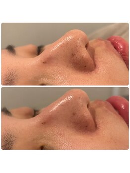 ネオファースト 大阪福島店(NeoFirst)/大人気！毛穴洗浄#毛穴#毛穴洗浄