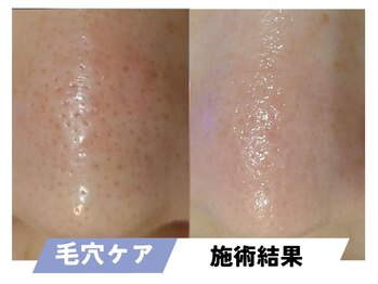 セルフィッシュビューティー/毛穴ケア／施術結果