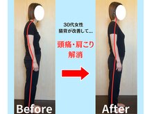 ソヴァール(SAUVEUR)/30代女性　猫背による頭痛肩こり