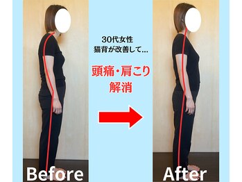 ソヴァール(SAUVEUR)/30代女性　猫背による頭痛肩こり